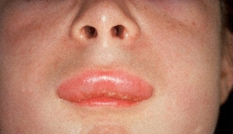 Флегмона челюстно-лицевой области